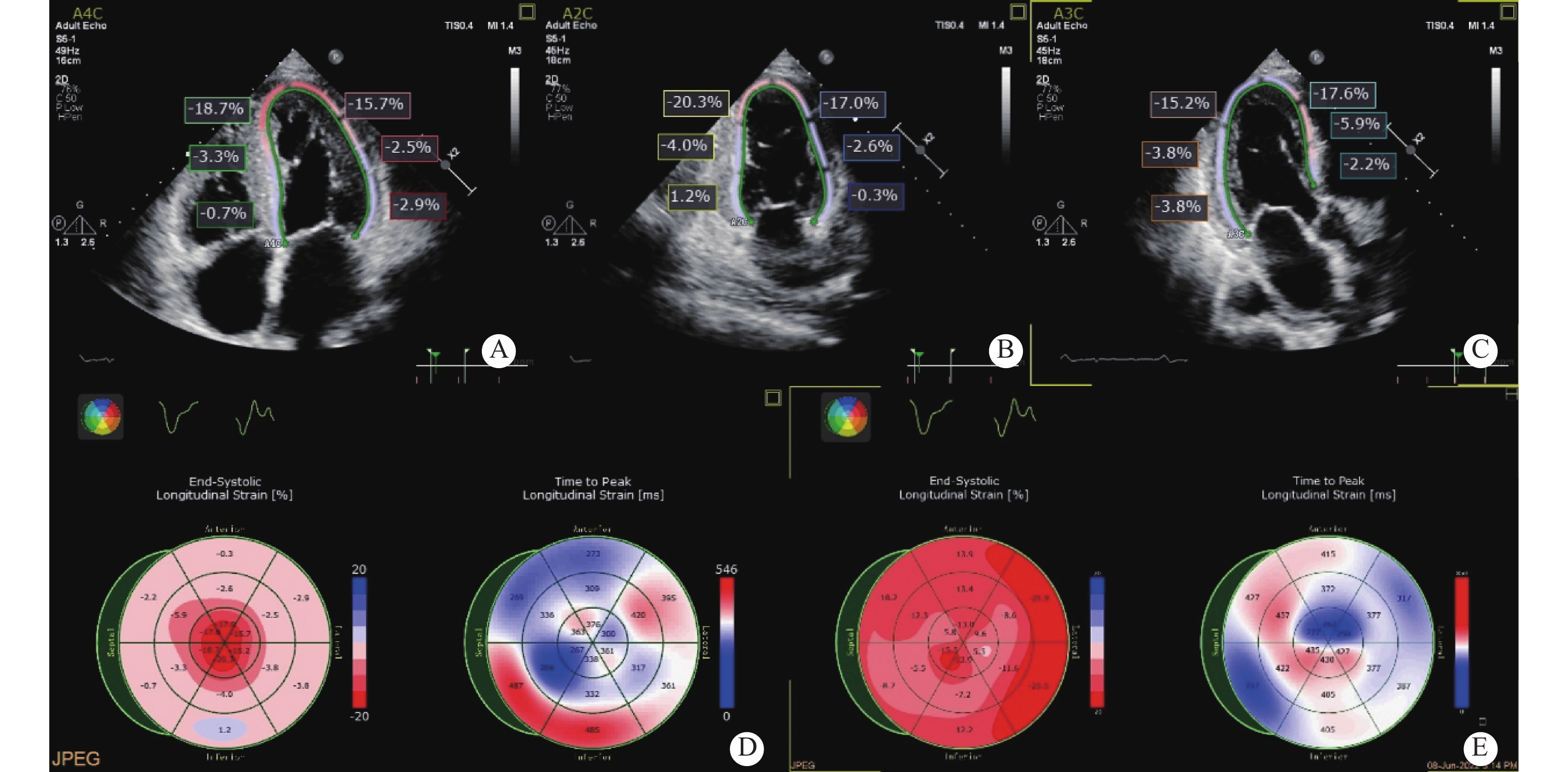 免疫球蛋白轻链型心脏淀粉样变二维斑点追踪超声心动图特征